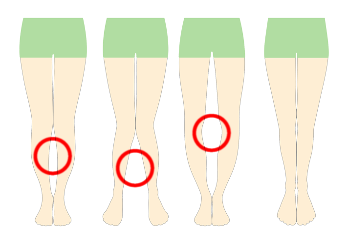 美脚矯正（O脚矯正）